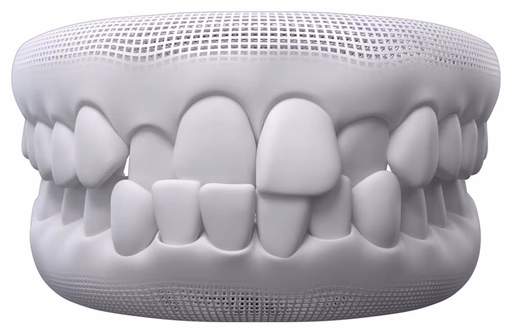 Crossbite