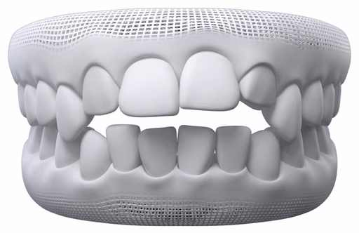 Open Bite