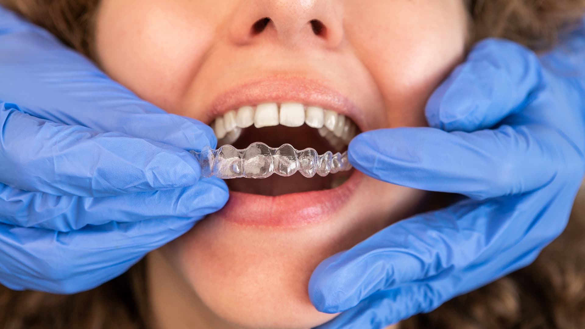 Invisalign consultation at Aries Clinic Dubai